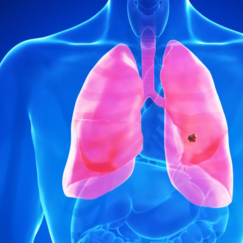 fda oks new next gen pill for rare lung cancer 684b11a84f4b4