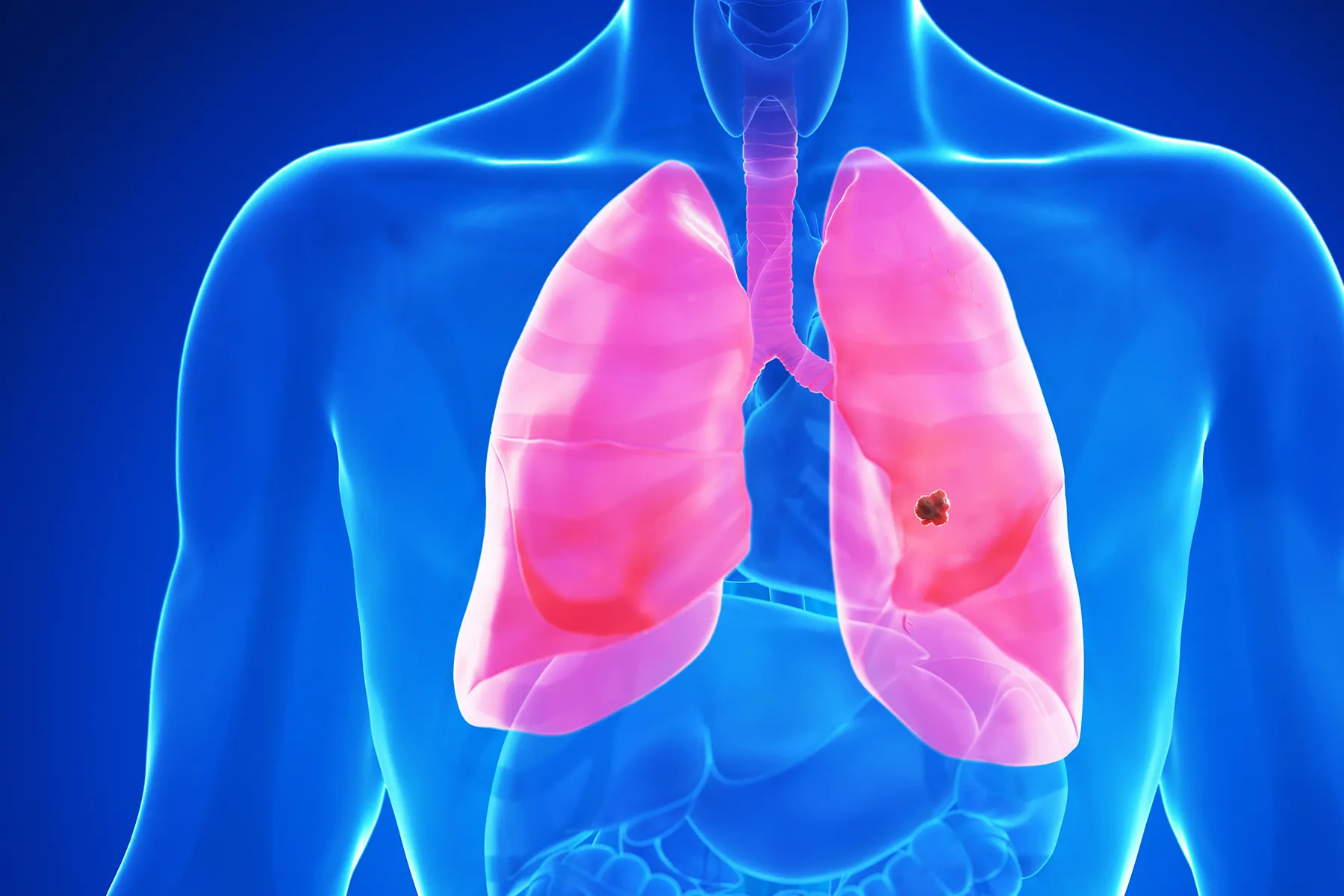 FDA aprobă o nouă pastilă inovatoare pentru cancerul rar de plămâni