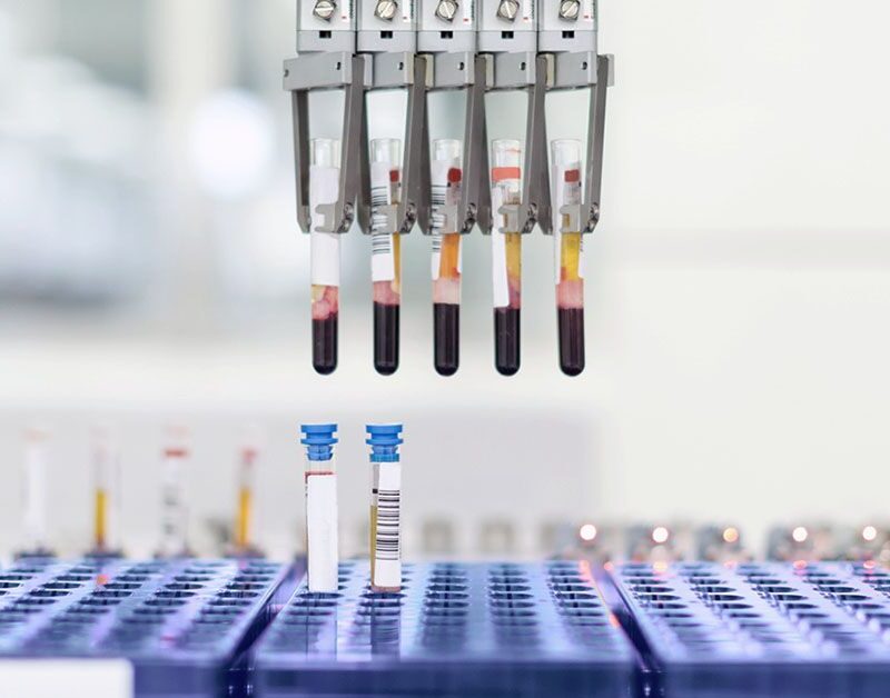 insulin resistance test may help predict early alzheimers cognitive decline rate 685fd5481a92d