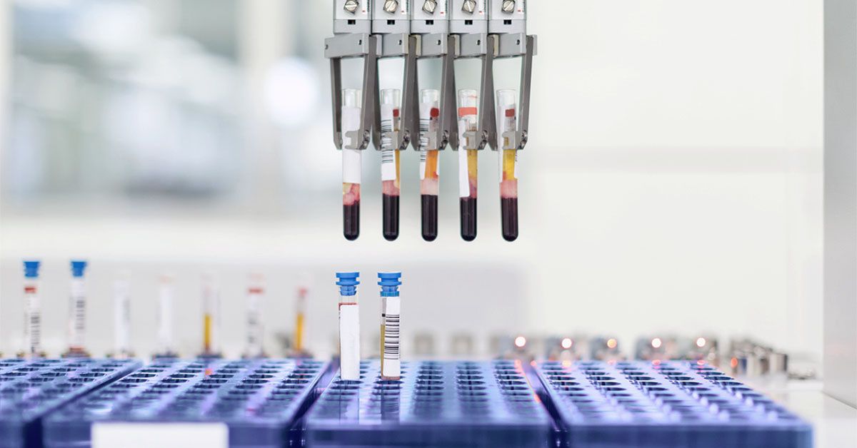 Testul pentru rezistența la insulină ar putea prezice rapiditatea declinului cognitiv în stadiile incipiente ale Alzheimerului