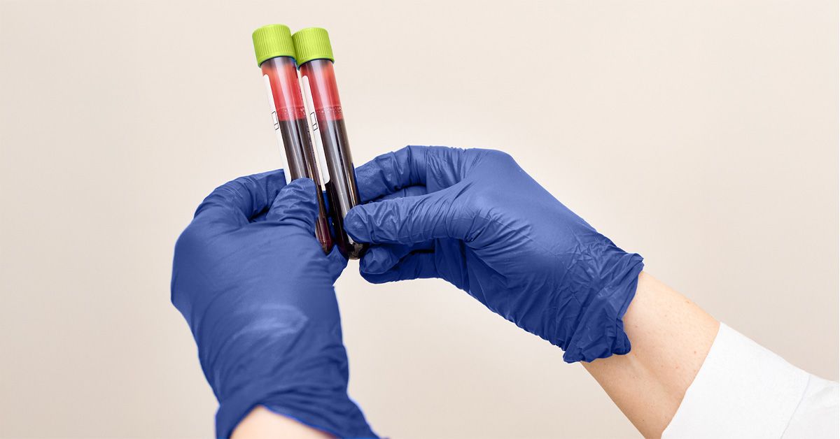 Un nou test de sânge ar putea identifica boala celiacă fără a provoca simptome