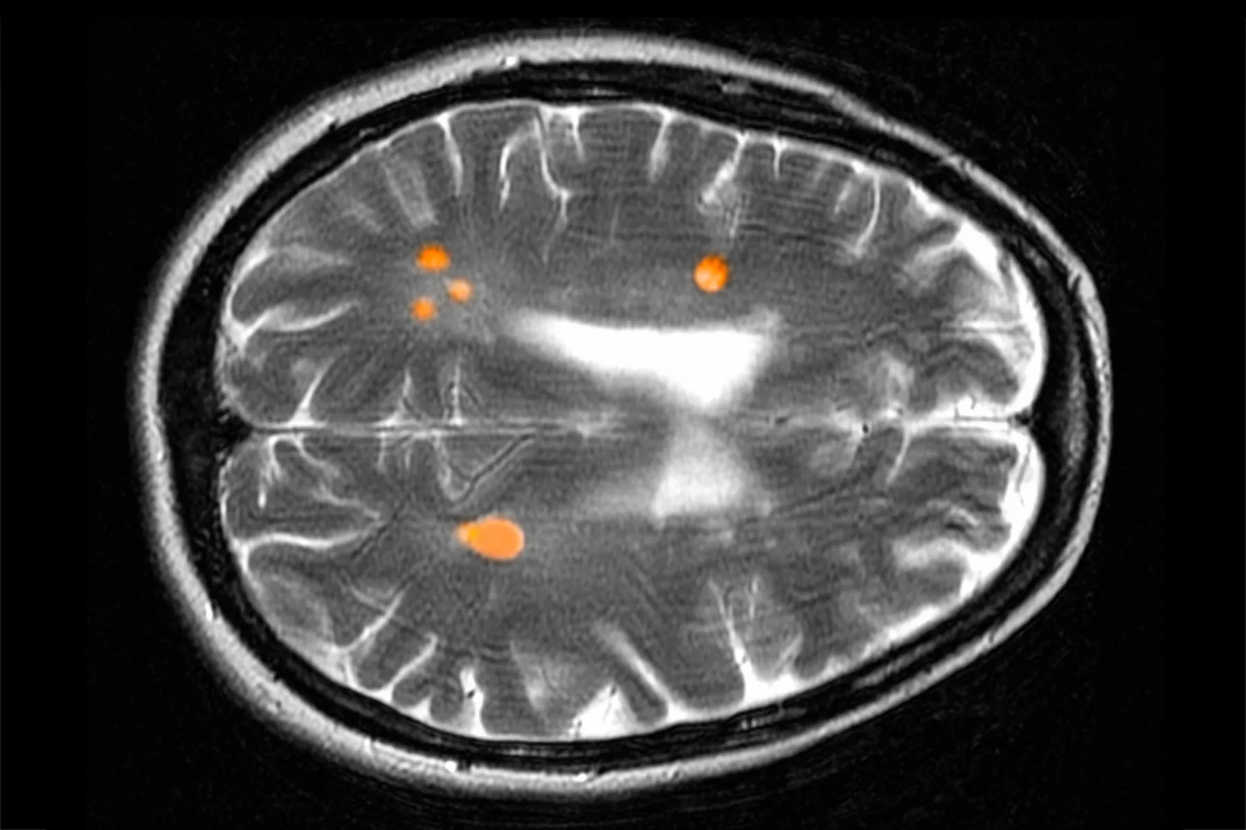 Eforturile de a depista scleroza multiplă cu ani înainte de apariția simptomelor