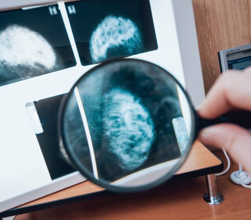 14 mituri si adevaruri despre cancerul mamar 68ff9f87ea91f