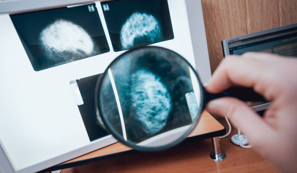 14 credințe și realități despre cancerul mamar