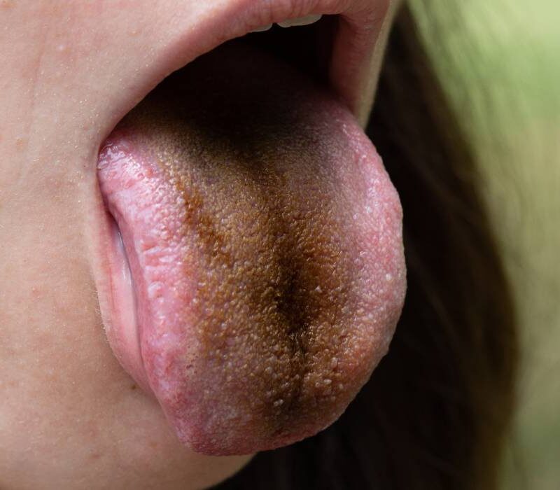 de ce ai limba neagra paroasa si ce carente indica 69032b7c3d3af