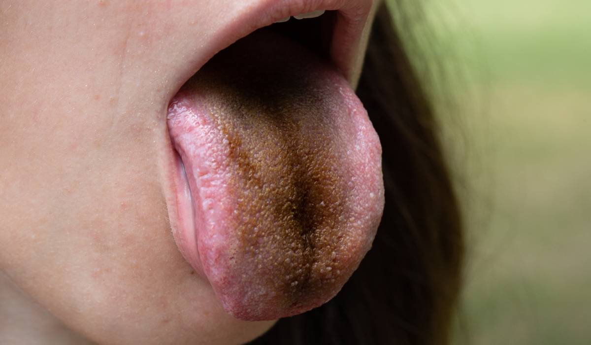 Cauzele și semnificațiile limbii negre și pârloase