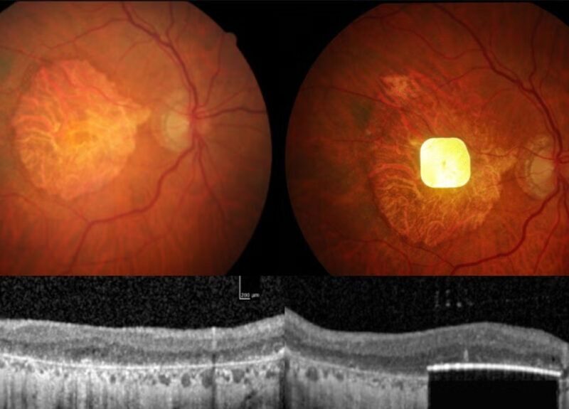 new retinal implant may restore central vision in people with advanced amd 6903479793c70