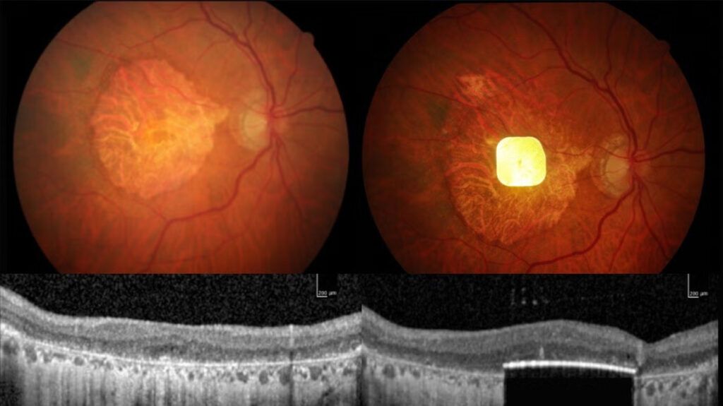 Un nou implant retinal promite să redă vederea centrală persoanelor afectate de AMD avansat