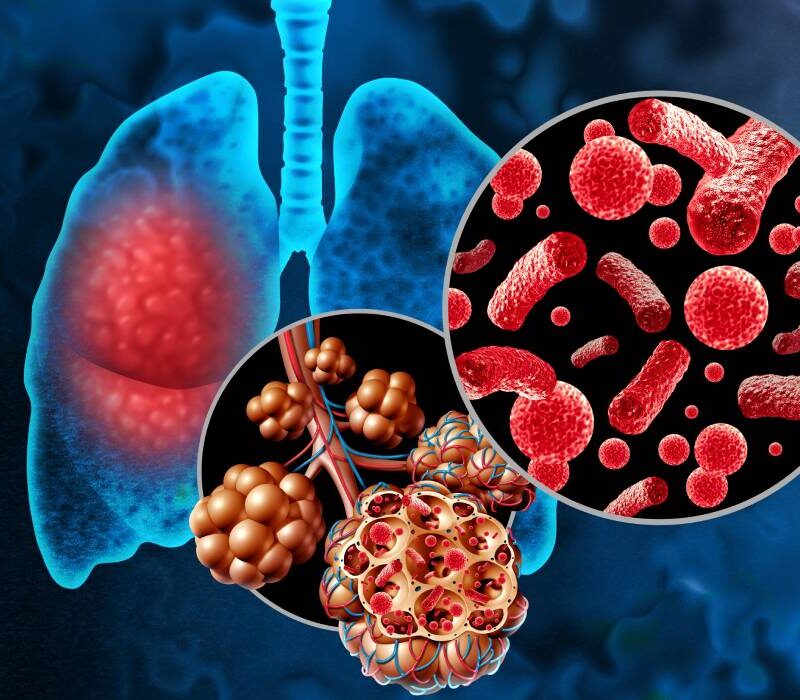 cum deosebesti o simpla raceala de pneumonie semne care nu trebuie ignorate 691601fc9b117