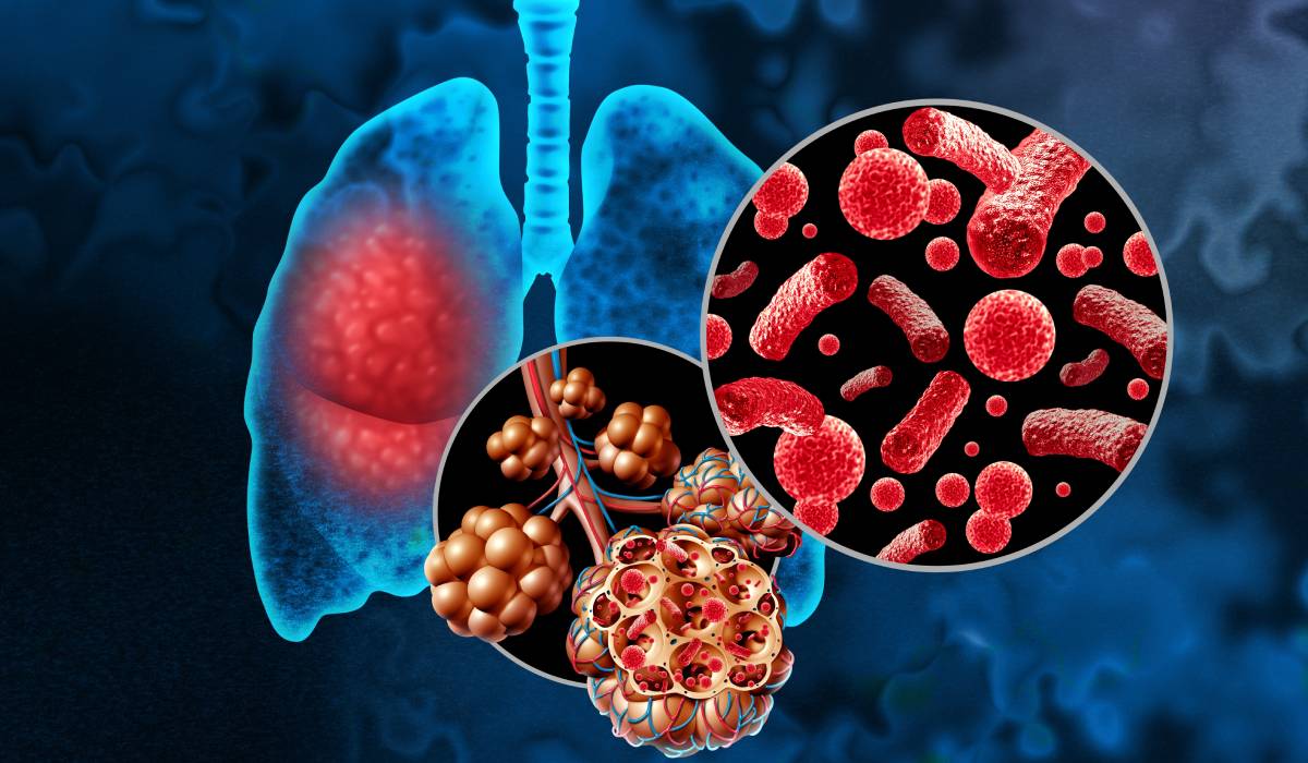 Cum să distingi o răceală obișnuită de pneumonie: indicii esențiali de avut în vedere
