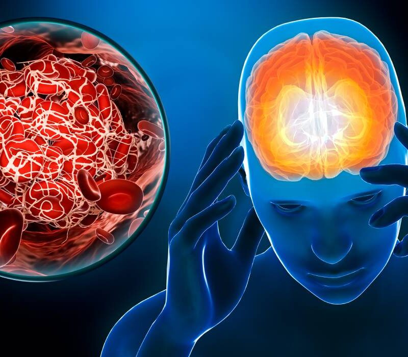 cum sa recunosti simptomele unui accident vascular cerebral sfaturile neurologului 6905a452c183e