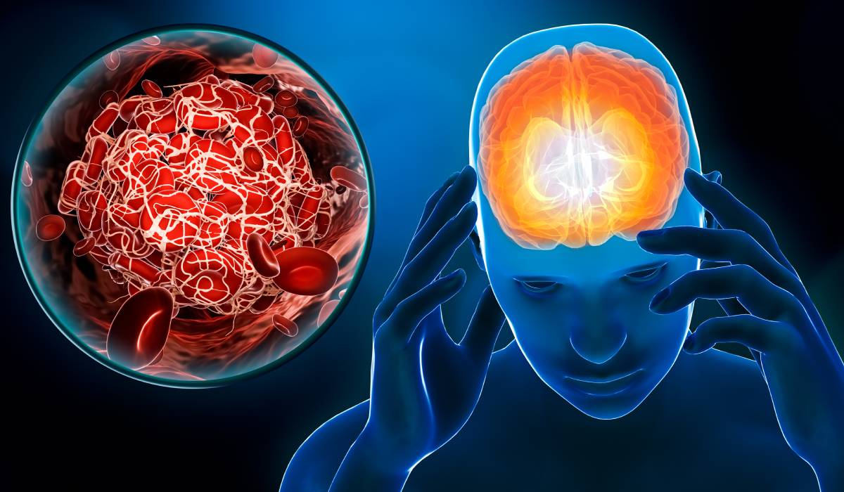 Ghidul neurologului pentru identificarea semnelor unui accident vascular cerebral