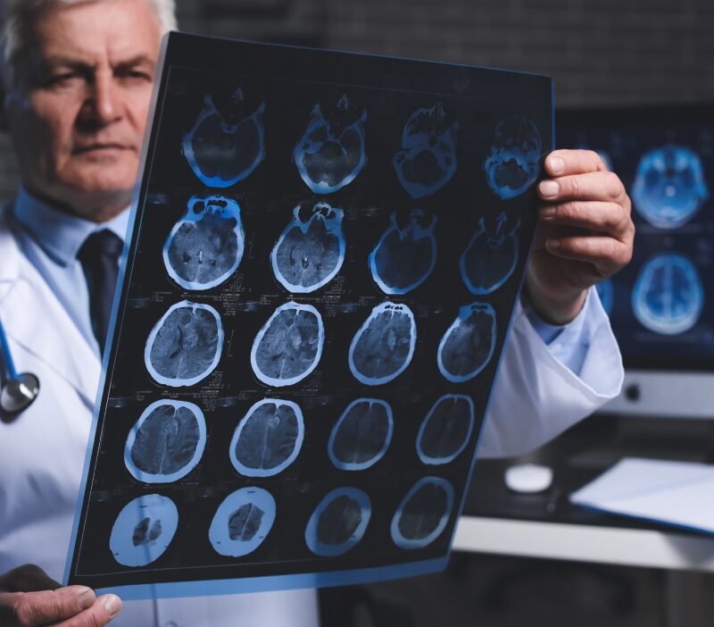 semnul subtil al dementei primul simptom nu e pierderea memoriei 692957fd01670