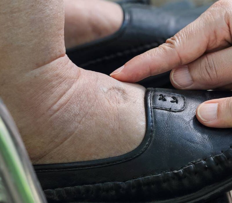 ai picioare umflate boli grave care pot fi semnalate de aces simptom nu e de la consumul excesiv de sare si nici de la incaltaminte 693020bb86460