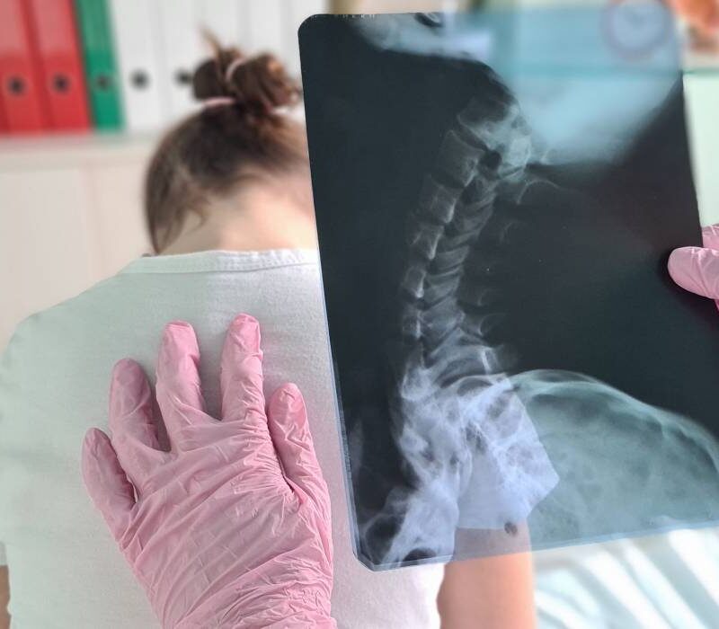 cele 4 semne vizibile care pot indica scolioza la copii afectiunea apare frecvent intre 10 si 15 ani 6a22755eab5c5