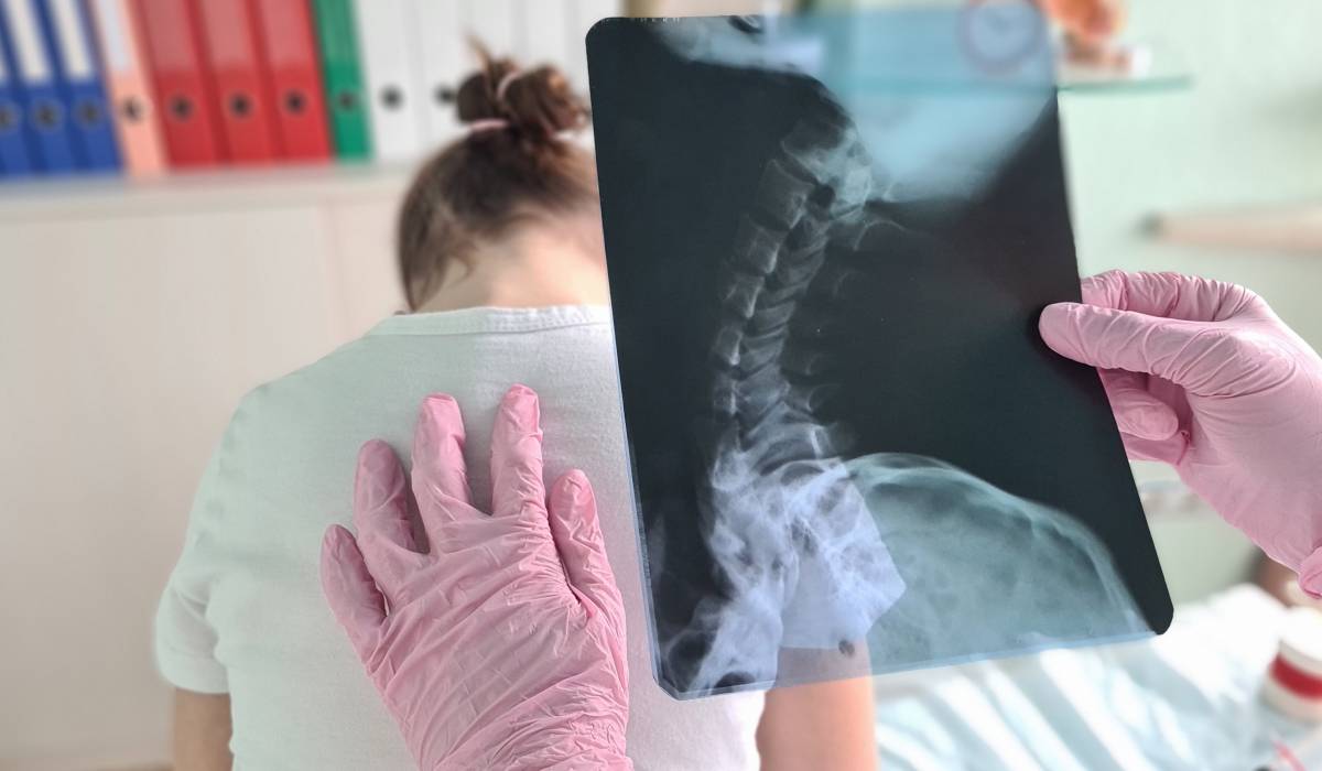 Patru indicatori esențiali care pot semnaliza scolioza la copii, o afecțiune frecventă între 10 și 15 ani
