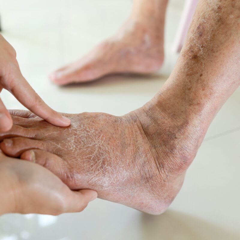 picioare umflate urina spumoasa si oboseala persistenta semne care pot indica probleme renale la persoanele cu diabet sau hipertensiune 6a37a9f742a10