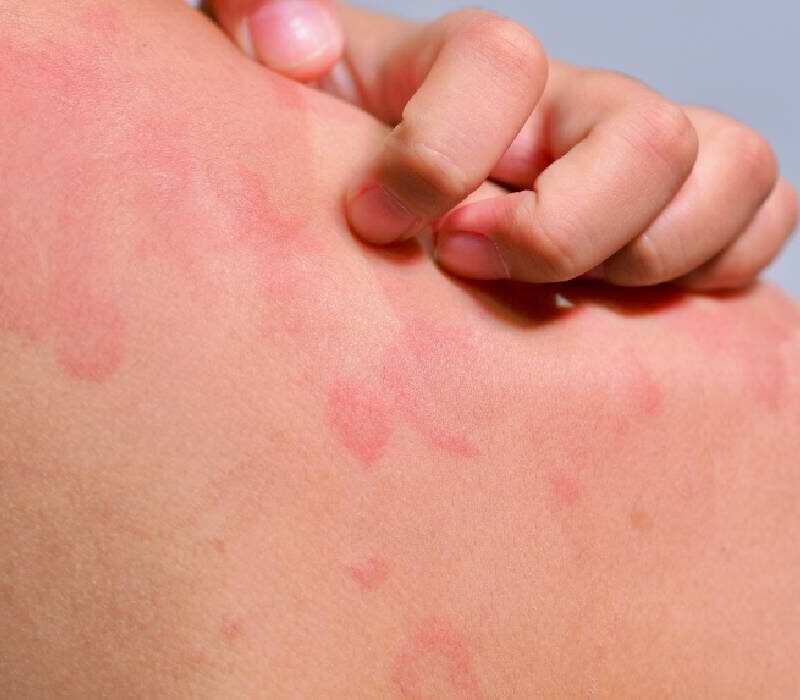 urticaria cronica spontana cat dureaza de ce apare si cand trebuie sa mergi la medic 6a2ea7906b9de