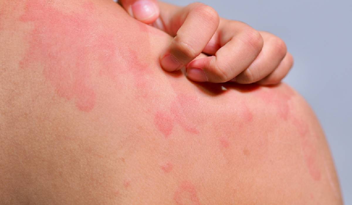 Urticaria cronică necontrolată: durata, cauzele și momentul potrivit pentru consultarea unui specialist