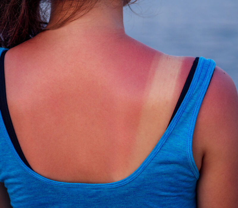 arsurile solare nu sunt inofensive cinci episoade pot creste semnificativ riscul de cancer de piele 6a51f9e483433