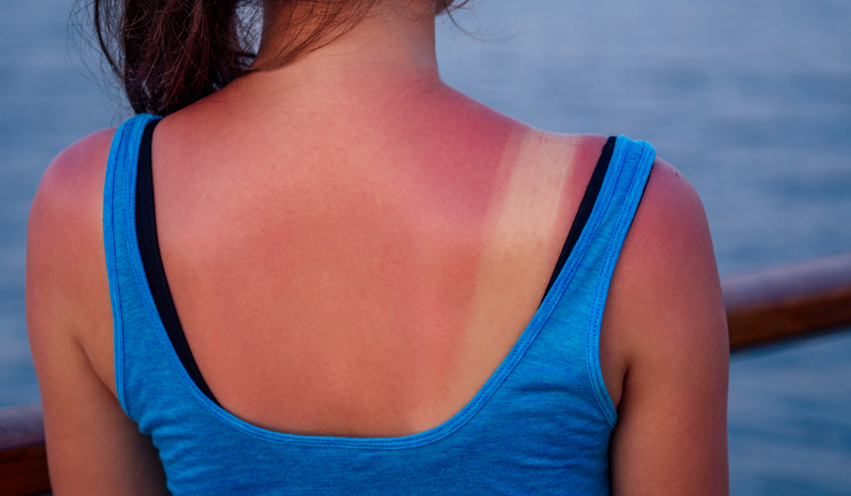 Arsurile solare: un pericol real pentru sănătatea pielii – cinci expuneri pot amplifica riscul de cancer cutanat