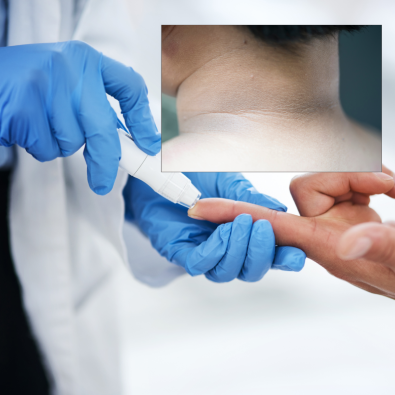 medicii avertizeaza o pata inchisa la culoare pe piele poate fi un semn al diabetului de tip 2 6a5f776790451