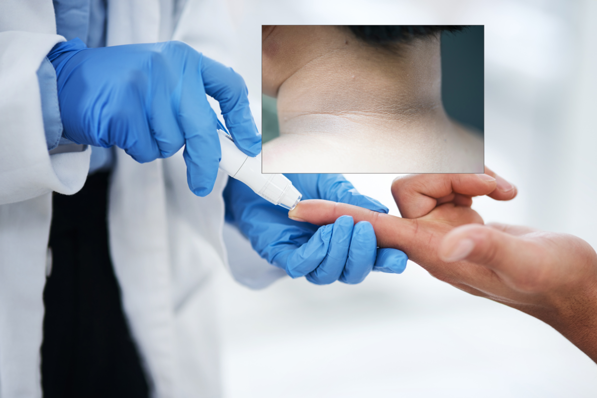 Atenție la semnele pielii: o pată închisă ar putea indica diabetul de tip 2