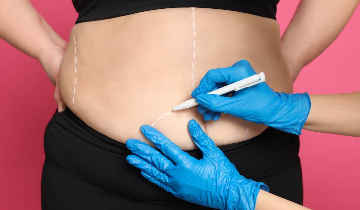 Transformarea estivală postchirurgicală bariatrică: redefinirea corpului și a relației cu sinele