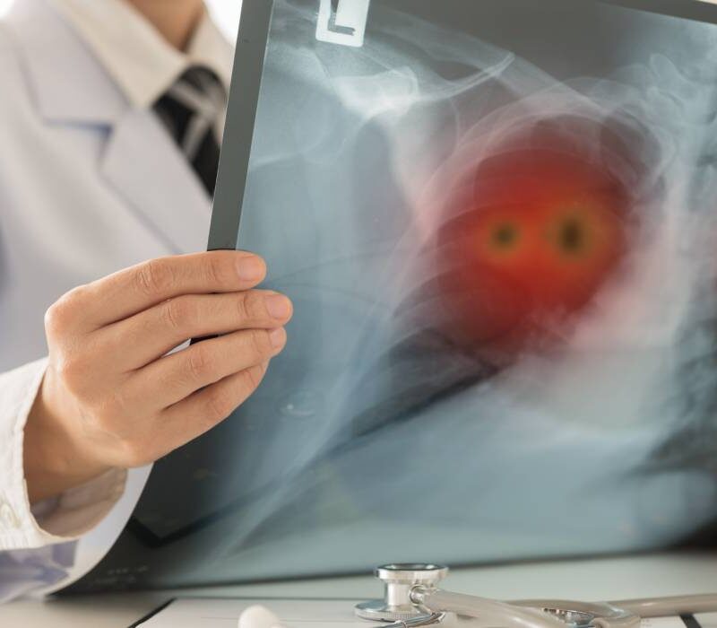 de ce fostii fumatori raman vulnerabili la bolile pulmonare ce se intampla in plamani dupa ce renunti la tigari 6a7c37f5befb5