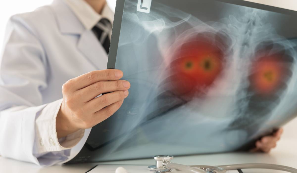 De ce foștii fumători sunt predispuși la afecțiuni pulmonare? Ce modificări apar în plămâni după abandonarea țigărilor