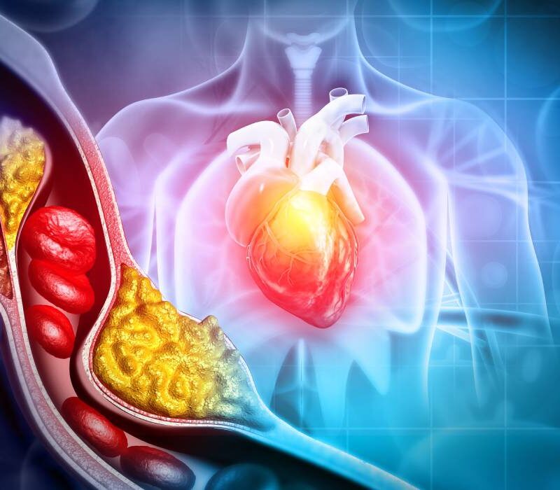 poti face infarct chiar daca ai colesterolul normal ce spun medicii despre riscul pe care analizele nu il arata 6a7eb6a15cf95