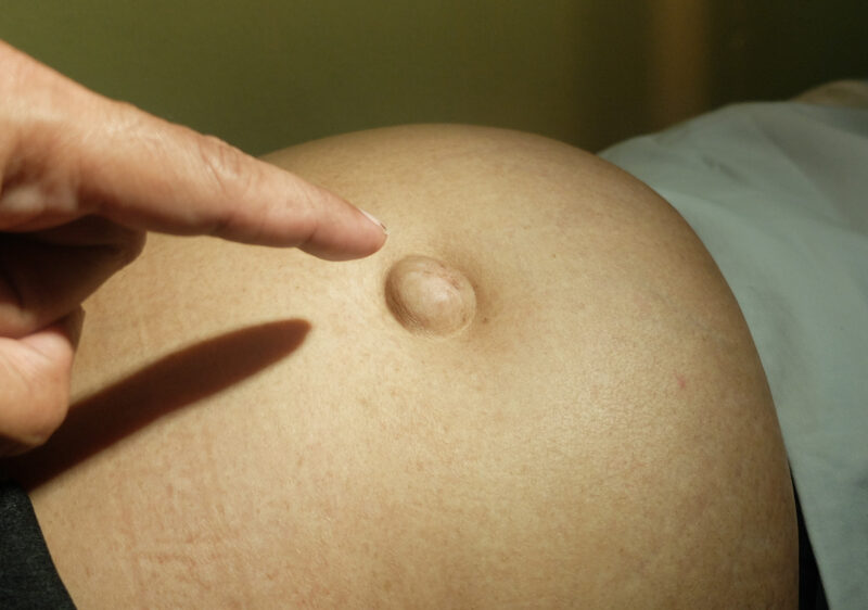 semnul vizibil pe abdomen care poate trada o hernie la inceput poate sa nu doara deloc 6a9139b14c7a8
