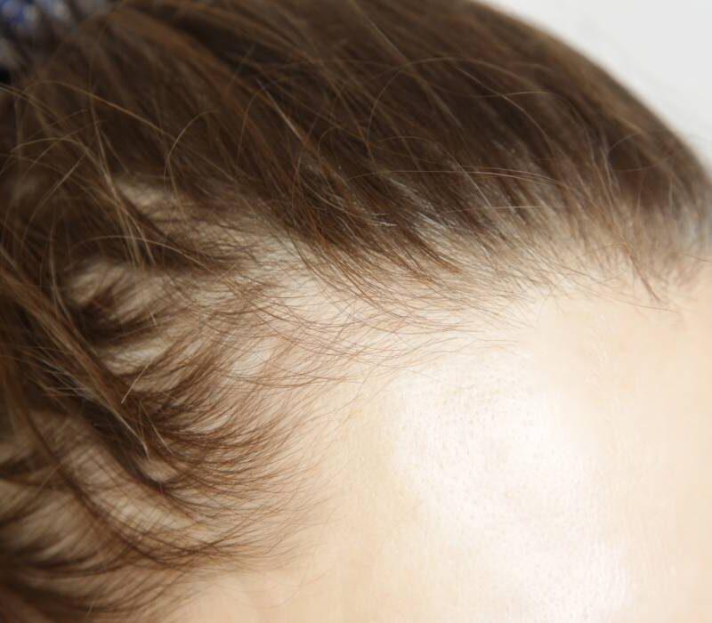 slabesti dar iti cade parul ce legatura au injectiile pentru slabit cu alopecia 6a7ddc7c51a98